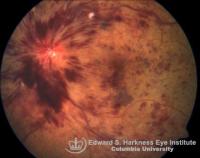 Flame-shaped hemorrhages in a case of central retinal vein occlusion. Note also the disc edema, dot-blot hemorrhages and cotton-wool spots.
